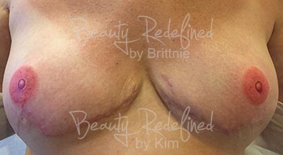 Areola/Nipple Breast Cancer Survivor After