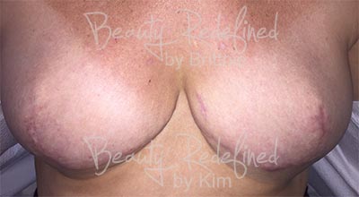 Areola/Nipple Breast Cancer Survivor Before