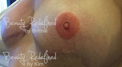 Areola/Nipple Breast Cancer Survivor After