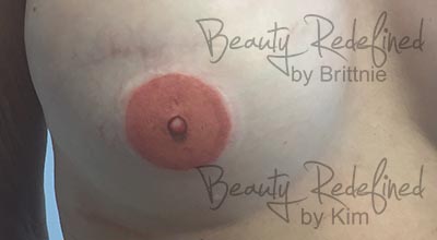 Areola/Nipple Breast Cancer Survivor After