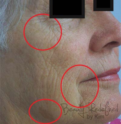 Microneedling/CIT