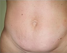 Cellulite After VelaShape