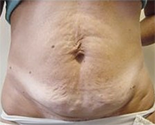 Cellulite Before VelaShape