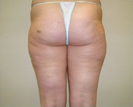 Cellulite After