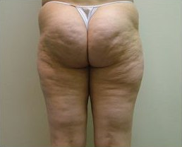 Cellulite Before