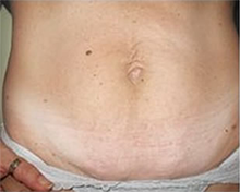 Cellulite During VelaShape