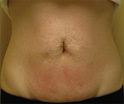Female Circumferential Reduction After
